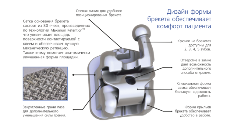 Проект брекеты исследовательский